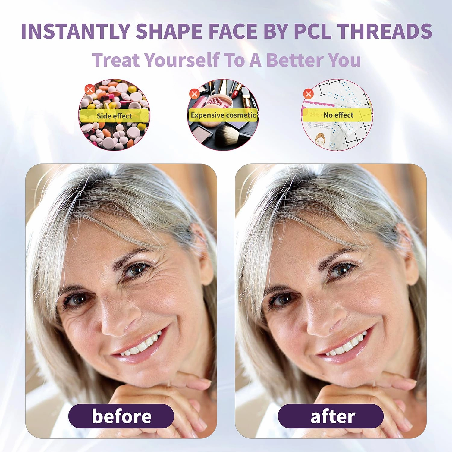 elves Cog Threads Face Lift PCL Threads Lift Skin Rejuvenation Collagen Threads for Face/Whole Body Lip Anti-Aging & Wrinkle Non-surgical Facelift for Eye Brow 18G100MM 20PCS