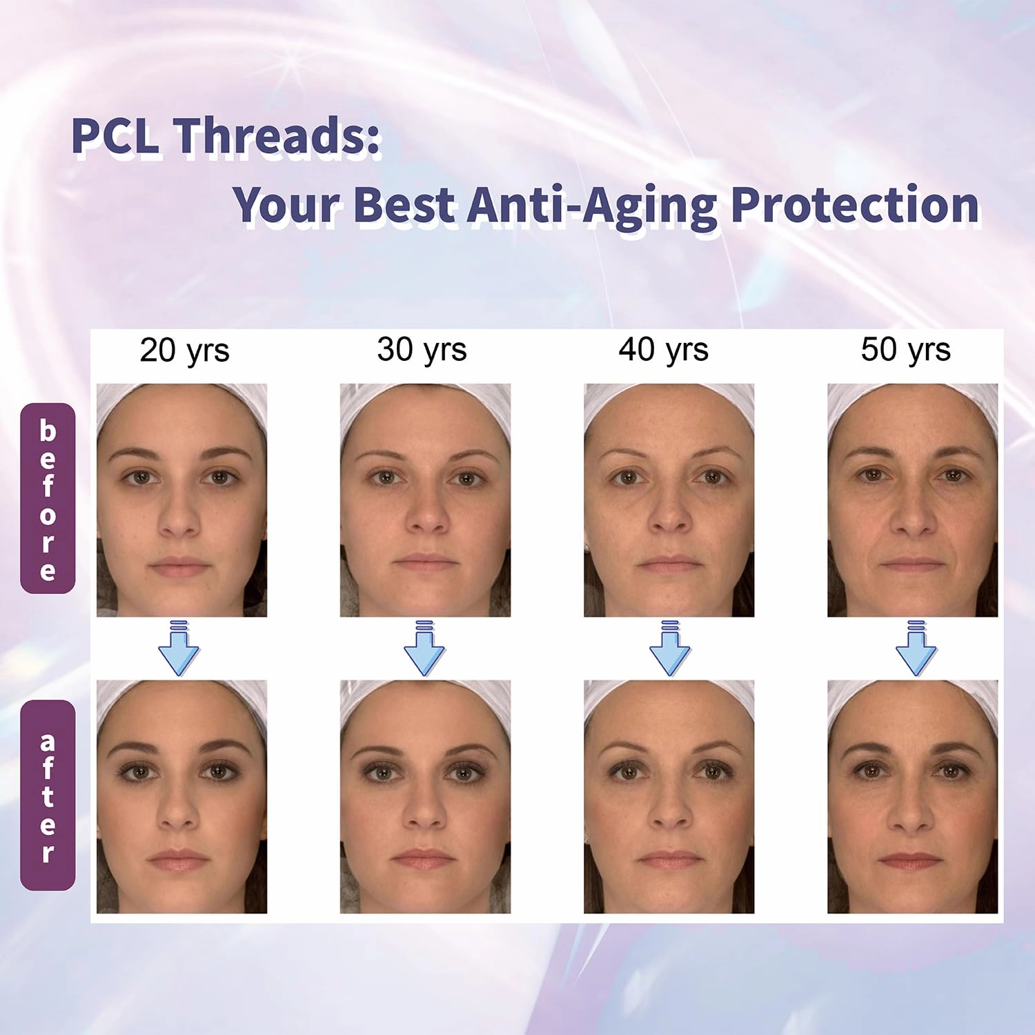 elves Cog Threads Face Lift PCL Threads Lift Skin Rejuvenation Collagen Threads for Face/Whole Body Lip Anti-Aging & Wrinkle Non-surgical Facelift for Eye Brow 18G100MM 20PCS