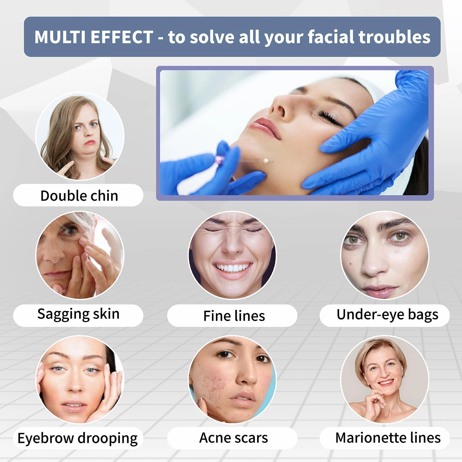 elves Cog Threads Face Lift PCL Threads Lift Skin Rejuvenation Collagen Threads for Face/Whole Body Lip Anti-Aging & Wrinkle Non-surgical Facelift for Eye Brow 18G100MM 20PCS